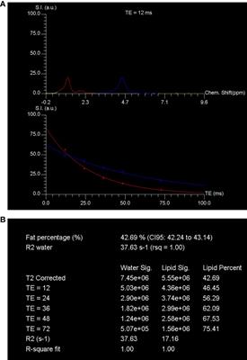 Associations of marrow fat fraction with MR imaging based trabecular bone microarchitecture in first-time diagnosed type 1 diabetes mellitus